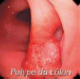 Parlonssante.com Image-polype