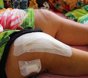 Une fois opérée, la patiente a pu rentrer chez elle. Infirmiers, anesthésistes, chirurgiens et kinésithérape effectuent leurs soins et visites à domicile. Crédit photo : Parlonssante.com